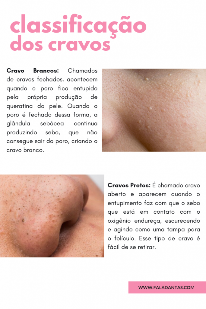 CRAVOS NO ROSTO: Como remover? » Fala, DantasFala, Dantas