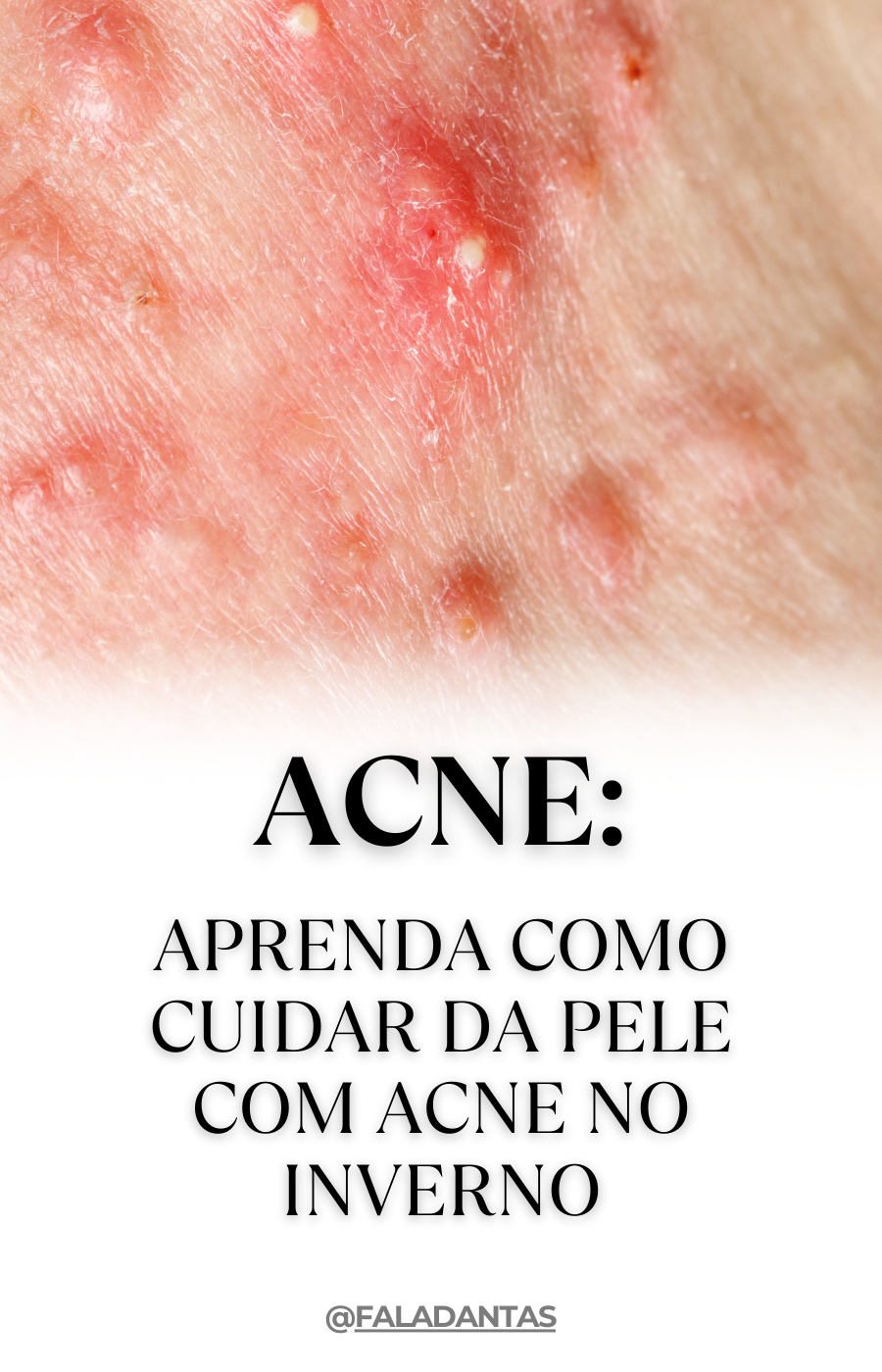 Como cuidar da pele com acne no inverno